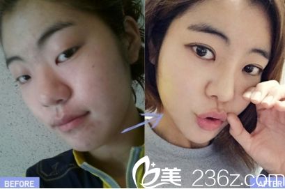 菏澤華美雙眼皮優(yōu)惠特價(jià)只需880元