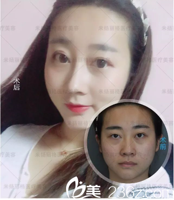 北京米揚麗格全臉填充加隆鼻真人案例