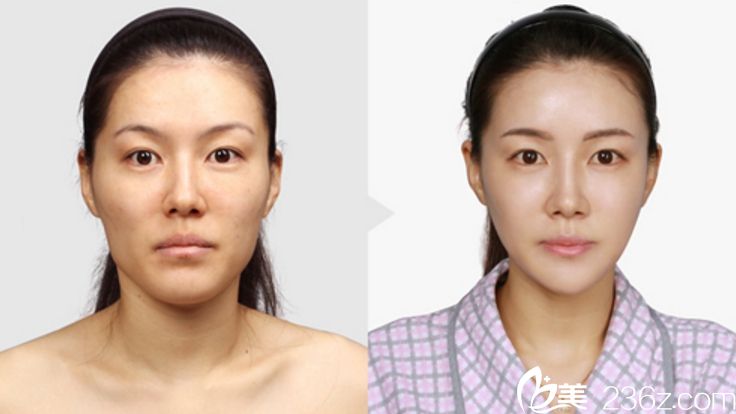 韓國(guó)顴骨降低哪家醫(yī)院好