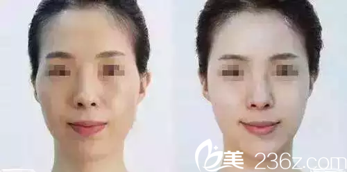 太陽穴凹陷填充后的效果