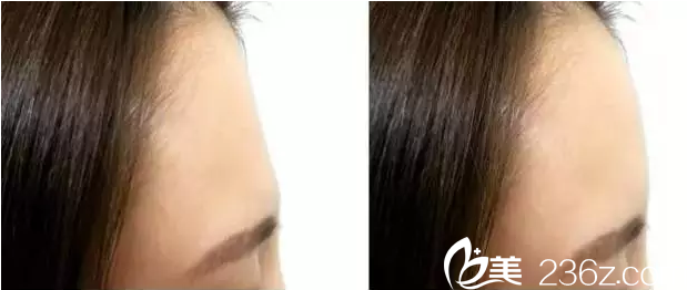 額頭凹陷填充后效果