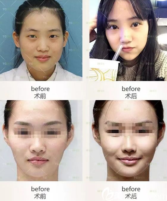 杭州時光注射玻尿酸填充蘋果肌案例