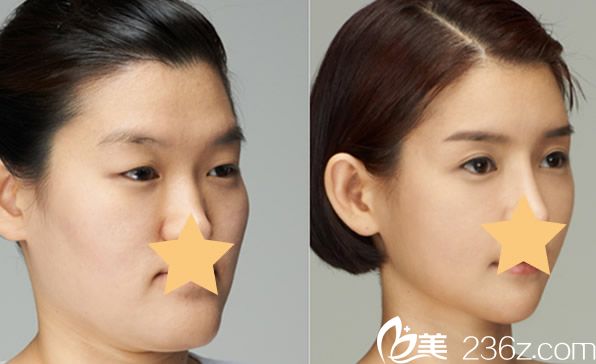 京美唐愛(ài)東醫(yī)生微拉美面部提升前后效果對(duì)比圖