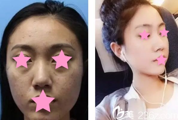 呼市京美面部脂肪填充三個(gè)月效果對(duì)比圖