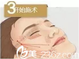 埋線提升術(shù)第三步