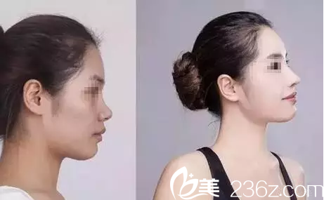 宇芳姬生態(tài)挺俏鼻綜合前后對(duì)比