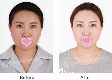 沈陽(yáng)百嘉麗真人注射前后效果對(duì)比