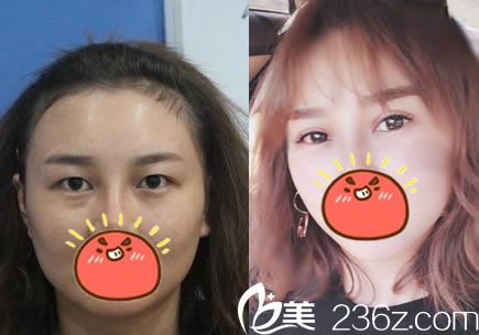 <!--<i data=20240703-sp></i>-->張?jiān)洪L(zhǎng)雙眼皮