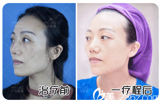 在廣州美萊做完超皮秒祛斑一個療程效果圖