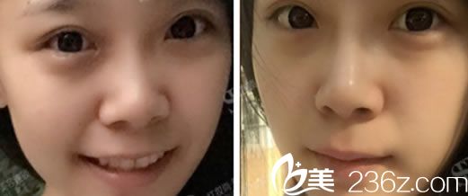 注射玻尿酸隆鼻手術(shù)案例