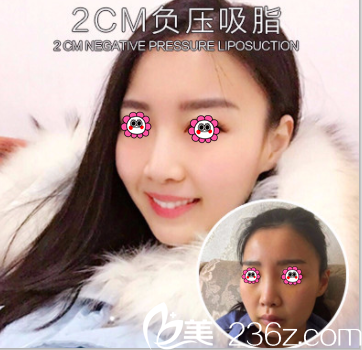 <!--<i data=20240703-sp></i>-->門診部張清峰面部吸脂案例