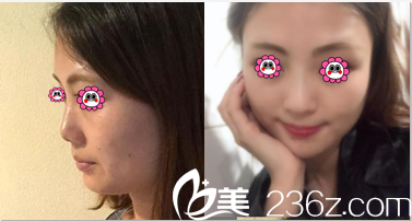 <!--<i data=20240703-sp></i>-->門診部閆立新鼻修復(fù)案例