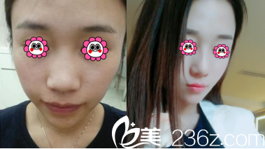 北京美萊劉金華鼻綜合案例