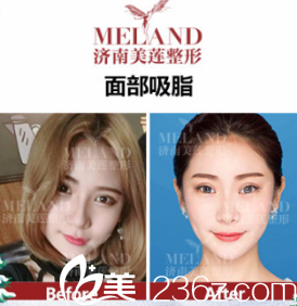 濟(jì)南美蓮面部吸脂案例