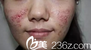 我朋友注射玻尿酸爛臉的樣子