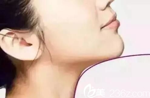 玻尿酸隆下巴多久能恢復(fù)自然？