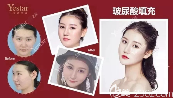 重慶藝星整形玻尿酸填充效果怎么樣