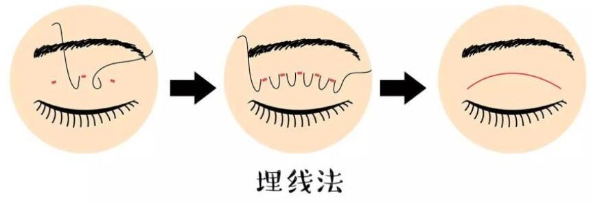 上海伯思立醫(yī)療美容門診部魏國茜講解埋線雙眼皮的做法 上海伯思立醫(yī)療美容門診部魏國茜講解埋線雙眼皮的做法