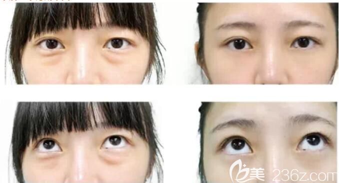 以為自己是浮腫型，面診常熟時代后才知道是脂肪型眼袋做了脂肪溶解、眶隔修復(fù)定制無痕祛眼袋