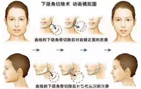 下頜角整形動(dòng)畫模擬圖