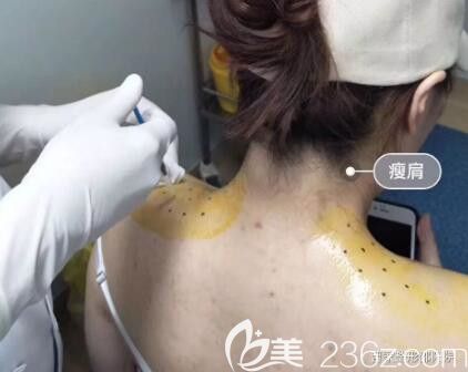 郴州曹家整形真人注射瘦肩過程