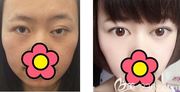 呼和浩特大韓整形失敗修復(fù)案例上線 韓國(guó)JK整形醫(yī)院白惠援院長(zhǎng)雙眼皮隆鼻修復(fù)失敗效果真的很自然