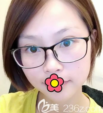 呼和浩特大韓整形咋樣 看陳琳院長(zhǎng)皮秒祛斑案例(網(wǎng)友說(shuō)激光祛斑后悔死了在我身上不存在)