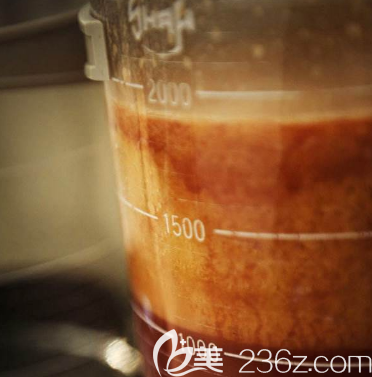 吸出來的脂肪圖片