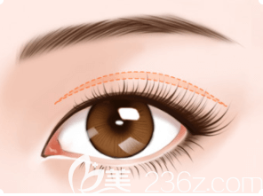 北京美萊割雙眼皮宣傳圖