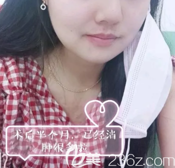 磨骨術(shù)后半個月照片