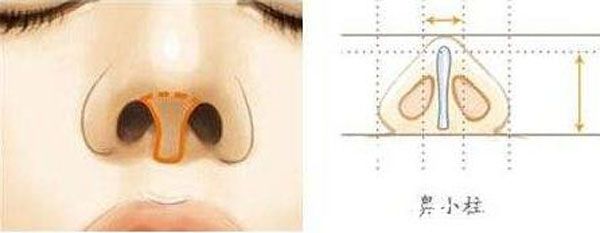 什么是鼻小柱延長