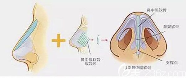 鼻小柱延長可以用玻尿酸嗎