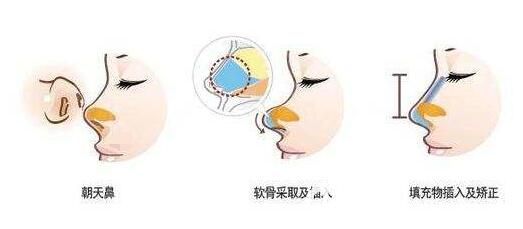 朝天鼻整容需要做鼻綜合整形