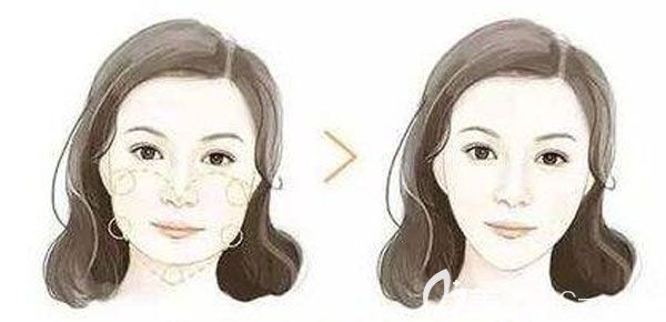 玻尿酸面部填充多久可以恢復(fù)