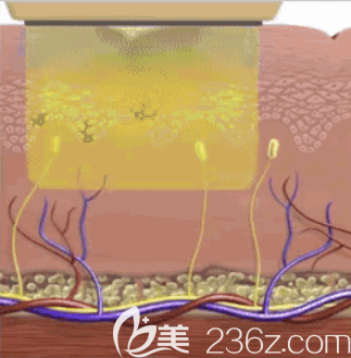 光子嫩膚作用皮層圖示