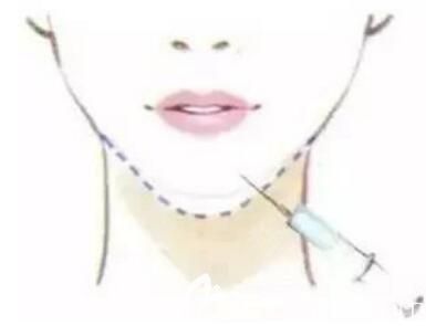 玻尿酸豐下巴幾天能消腫？