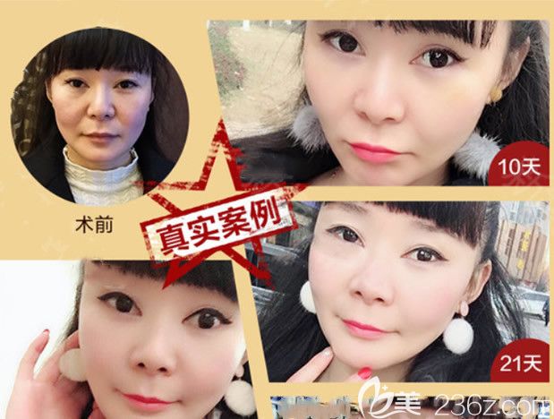 線雕一周后圖片