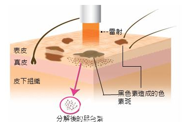 激光分解黑色素的過程