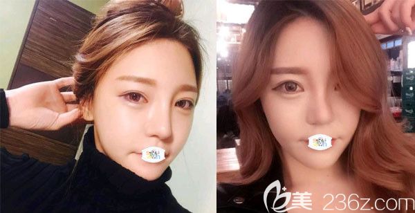 趁韓國原辰整形醫(yī)院價格表有優(yōu)惠活動做眼鼻胸+輪廓三件套后感慨整形的重要性！