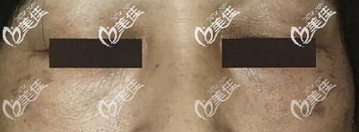 褐青色痣的突出表現(xiàn)