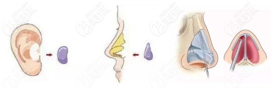 耳軟骨墊鼻尖會(huì)有吸收