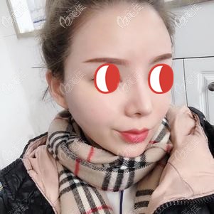 二次補膠后顧客面部自然飽滿