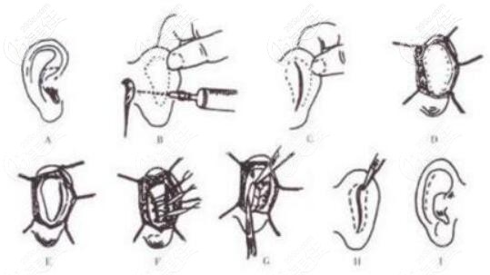 招風(fēng)耳矯正手術(shù)方法操作過程圖解
