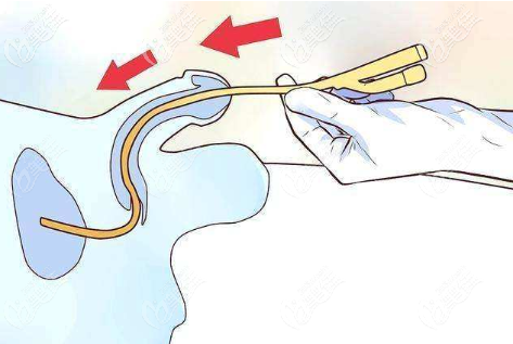 地包天后身體插著管子