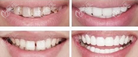 牙齒瓷貼面美白前后對(duì)比照