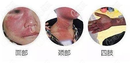 鮮紅斑痣的所在位置