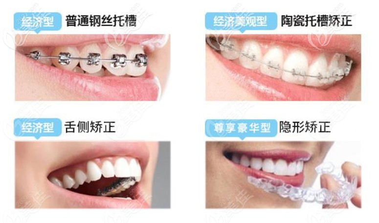 要做正畸的有這些整牙方式可以選擇