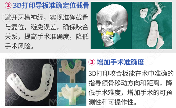 深圳何錦泉博士研發(fā)出的3D導(dǎo)板正頜技術(shù)很靠譜
