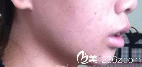 墊下巴手術(shù)|下巴整形