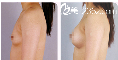 自體脂肪豐胸效果圖